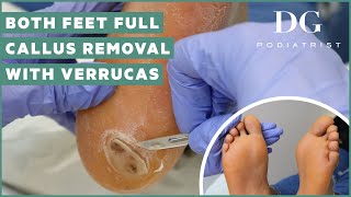 Callus removal from feet both feet and three verruca plantar warts treatment [upl. by Burrill]