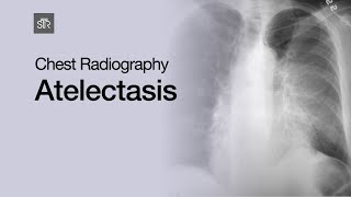 Chest Radiography Atelectasis [upl. by Delgado]