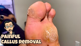 NEVER ENDING CALLUS REMOVAL FROM FEET [upl. by Dalia520]