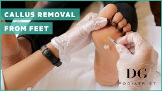 Callus removal from feet balls of feet [upl. by Trenton]