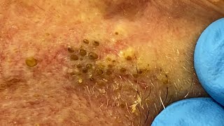 Extremely Clogged Pores Extracted  Contour Dermatology [upl. by Alegnaoj944]