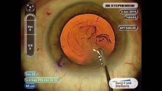 The Ophthalmic Exam Retina and Posterior Segment [upl. by Laband972]