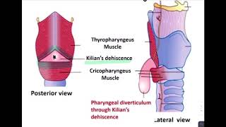 ESOPHAGEAL DIVERTICULUM [upl. by Friedlander]