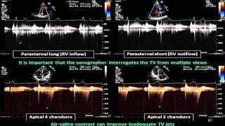 Pulmonary Hypertension and Echocardiographic parameters  BAVLS [upl. by Lechar]