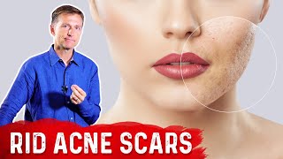 Best Way to Rid Acne Scars [upl. by Leira]