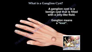 What Is A Ganglion Cyst  Everything You Need To Know  Dr Nabil Ebraheim [upl. by Wollis]