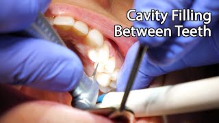 Dentist Filling A Cavity Between Teeth [upl. by Apfel]