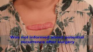 Chest Keloids  Mistakes to Avoid [upl. by Ecnaiva]