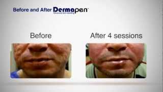 MicroNeedling Before and After  Dermapen® Treatment [upl. by Hairu700]