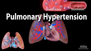 Pulmonary Hypertension Animation [upl. by Gerc]