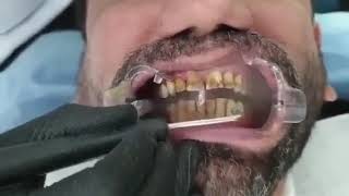 Teeth stain removal with Airflow [upl. by Vallie]