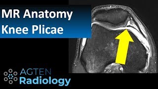 MRI Anatomy of Knee Plicae [upl. by Ennaylil151]