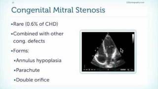 Mitral Stenosis Basics [upl. by Weathers997]