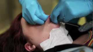 6g labret piercing procedure [upl. by Mixie]