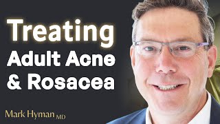 Treating Adult Acne amp Rosacea From The Inside Out [upl. by Ekyt]