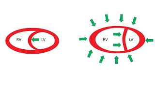 What Is Pulmonary Arterial Hypertension  WebMD [upl. by Mehcanem]