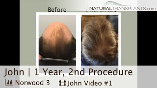 Norwood 3 Hair Transplant Results After Second Coat of Paint  Dr Blumenthal John [upl. by Foote971]