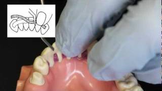 Ribbond Periodontal Splint Technique [upl. by Lazes]