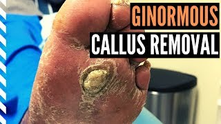 Ginormous Callus Removal [upl. by Mot]