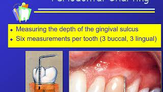 Charting Sequence and Periodontal Charting [upl. by Yseulte]