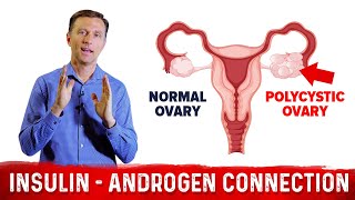 Why Does Insulin Cause PCOS Polycystic Ovary Syndrome – DrBerg [upl. by Rednal]