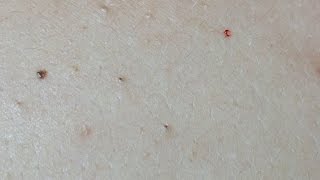 Acne Treatment on the Back Uninfected Lesions [upl. by Adilem]