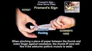 Froments Sign  Everything You Need To Know  Dr Nabil Ebraheim [upl. by Lalib]