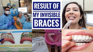 My INVISALIGN Treatment Result🦷 Was This Expensive Process Worth It [upl. by Norwood]