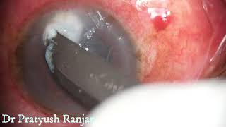 Therapeutic Corneal Ulcer Scraping [upl. by Eardnaed]