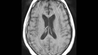 Herpes Encephalitis [upl. by Onida]