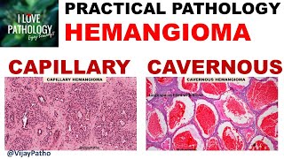 HEMANGIOMA capillary amp Cavernous Clinical features amp Morphology [upl. by Firestone]