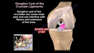 Ganglion Cysts Around The Knee  Everything You Need To Know  Dr Nabil Ebraheim [upl. by Eidnas]