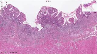 Celiac Disease  Clinical Presentation [upl. by Nwahsyar]