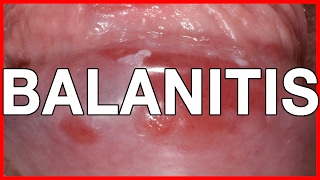 Balanitis Symptoms Causes Treatment and Prevention [upl. by Hal719]