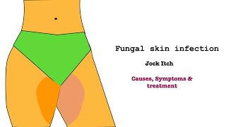 Jock itchFungal Infection on skinTineaRingwormFungal infection on nailtreatment and prevention [upl. by Snook333]