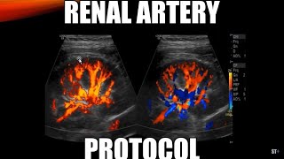 Renal Artery Doppler Protocol  Sonoquickies [upl. by Adnwahsor]