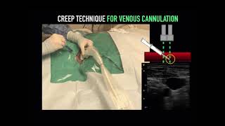 Bilateral ICA amp Unilateral Subclavian Stenosis  Case Study [upl. by Norag]