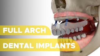 Full Arch Dental Implants [upl. by Flight]