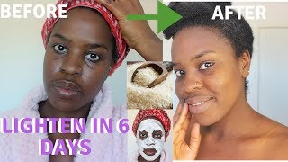 How I How i BRIGHTENED MY SKIN IN 6 DAYS REALISTIC and Natural way to reduce hyperpigmentation [upl. by Slerahc653]