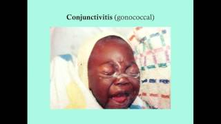 Conjunctivitis  CRASH Medical Review Series [upl. by Maibach]