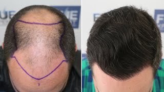 FUE Hair Transplant 4766 Grafts NW V By Dr Juan Couto  FUEXPERT CLINIC Madrid Spain [upl. by Case]