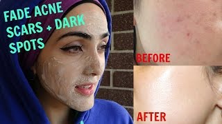 How To Get Rid of Acne Scars amp Hyperpigmentation NATURALLY AT HOME Tx for ALL Skin Types  Immy [upl. by Swaine]