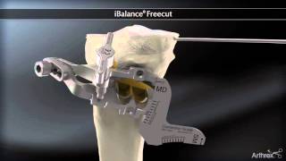 Chirurgie de lArthrose Osteotomie tibiale de valgisation Dr Philippe Loriaut [upl. by Tav]