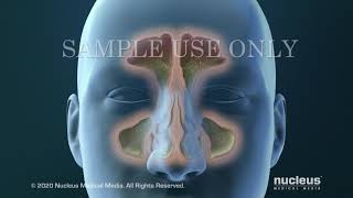 Sinusitis Surgery [upl. by Enymsaj]