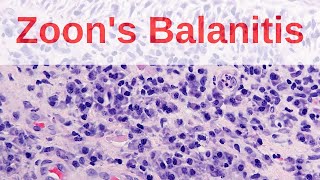 Zoons Balanitis  Pathology mini tutorial [upl. by Rory602]