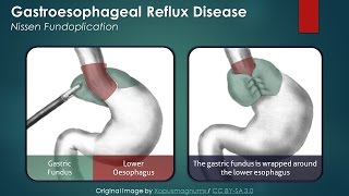 Nissen Fundoplication for GERD Symptoms amp Experience [upl. by Suehtomit]