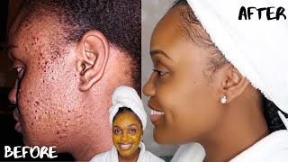 HOW TO GET RID OF ACNE SCARS AND DARK MARKS FAST  DIY TURMERIC HONEY LEMON AND ALOE FACE MASK [upl. by Ane]