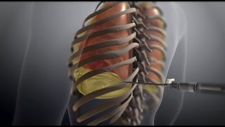 Thoracentesis [upl. by Court]