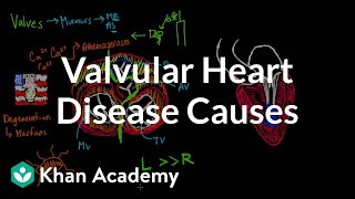 Tricuspid atresia  Circulatory System and Disease  NCLEXRN  Khan Academy [upl. by Fein]