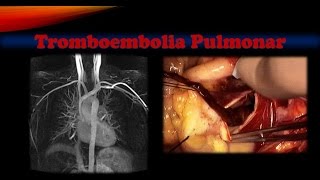 Tromboembolia pulmonar [upl. by Anaujahs]